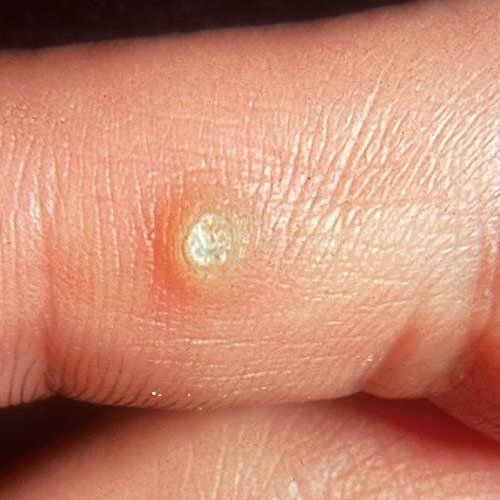 Warts on hands types Hpv warts finger