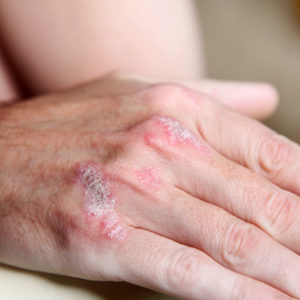 Hand with Psoriasis